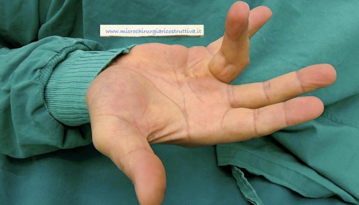 Ingegneria dei tessuti, la colla che elimina la Malattia di Dupuytren - 