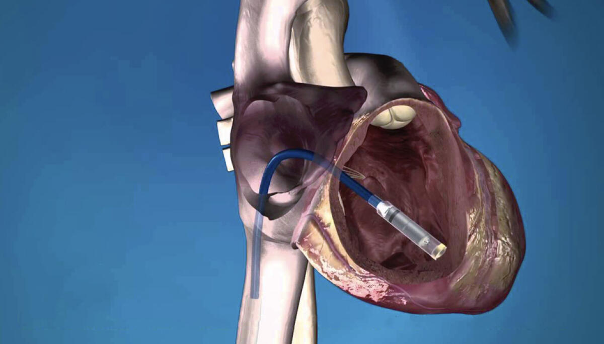 Bari: impiantato al policlinico il pacemaker più piccolo del mondo - 