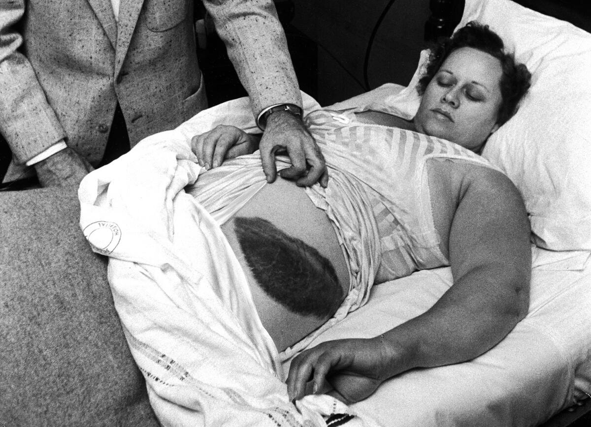 La storia di Ann Elizabeth Hodges - American Dr Moody Jacobs shows a giant bruise on side and hip of his patient, Ann Elizabeth Hodges (1923 - 1972), who had been struck by a meteorite while inside her home, Sylacauga, Alabama, late 1954. (Photo by Jay Leviton/Time &amp; Life Pictures/
