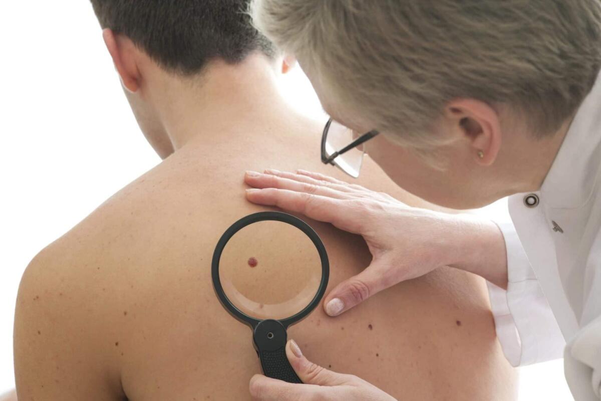 Tumore della pelle: scoperto miR-579-3p, l'RNA che ne blocca la crescita - Nei, credits: ladyblitz.it