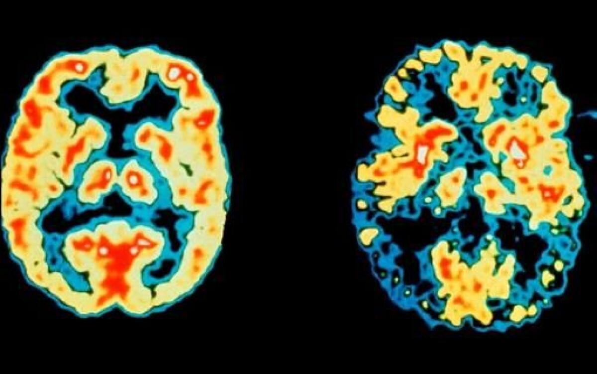 Alzheimer, aducanumab: il farmaco che riduce le placche nel cervello - Brain: normal (left) alzheimer (right), credits: http://images0.zurnal24.si/