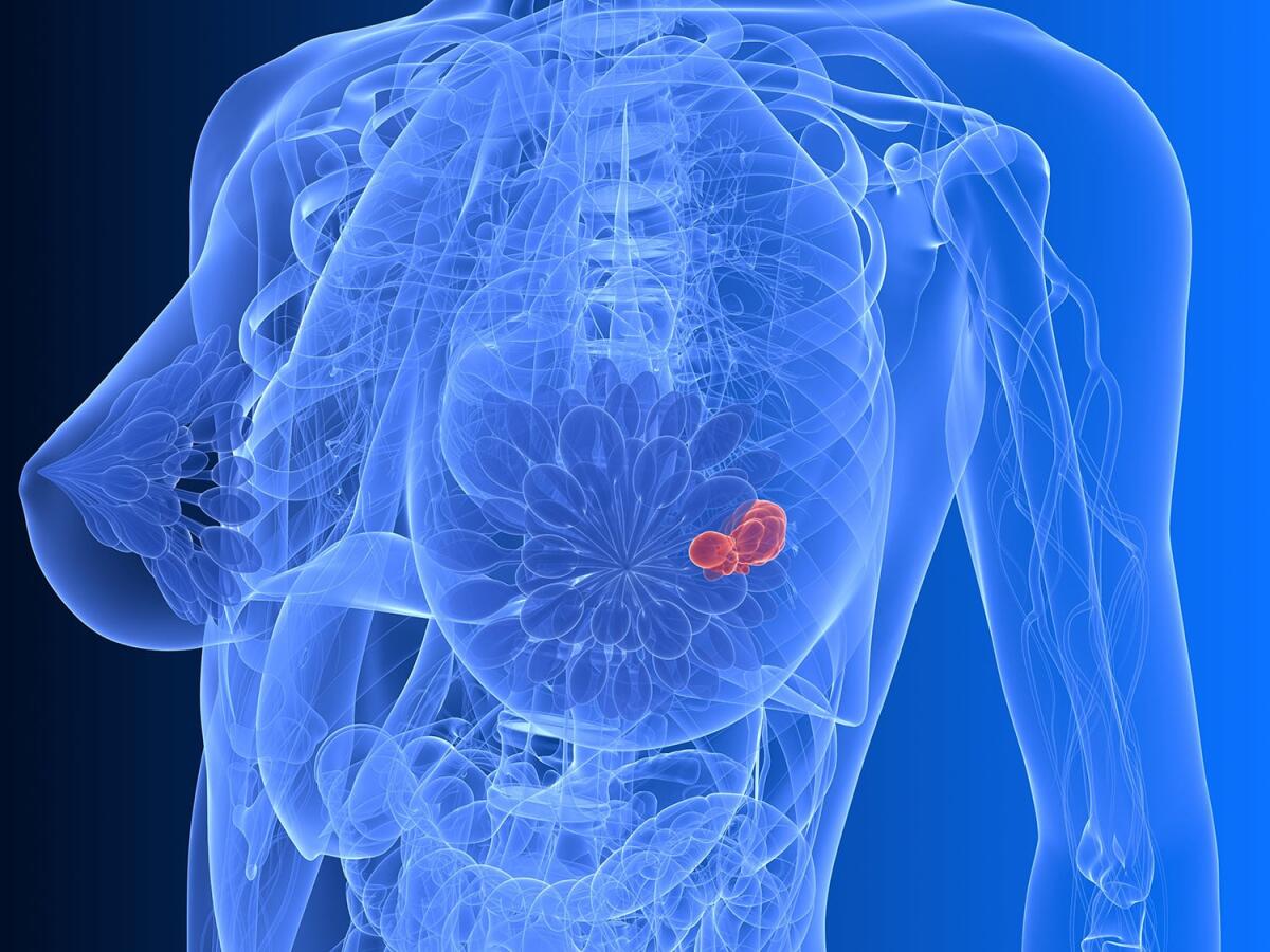 Un vaccino per sconfiggere il cancro al seno - Tumore al seno, credits: opuholi.org