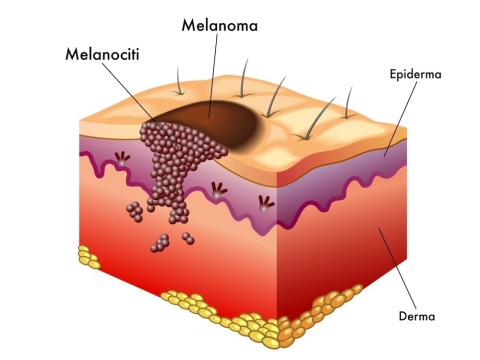 Diversi strati della pelle con esempio di melanoma http://static.piusanipiubelli.it