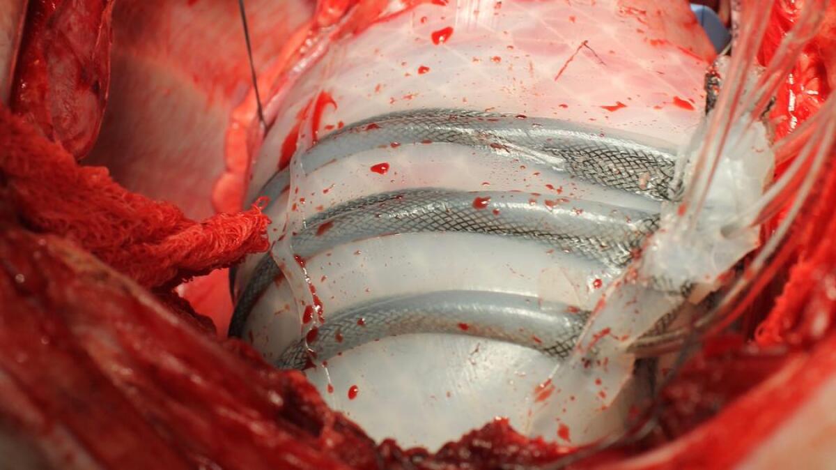 Insufficienza cardiaca: ecco Il soft robot che aiuta il cuore a battere - Soft robot cardiaco 
motherboard-images.vice.com