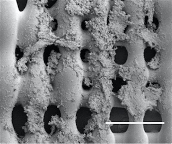 Cellule del sarcoma di Ewing sullo scaffold stampato in 3Dhttp://news.rice.edu/files/2017/02/0213_SARCOMA-1-web-1wwp0ps.jpg