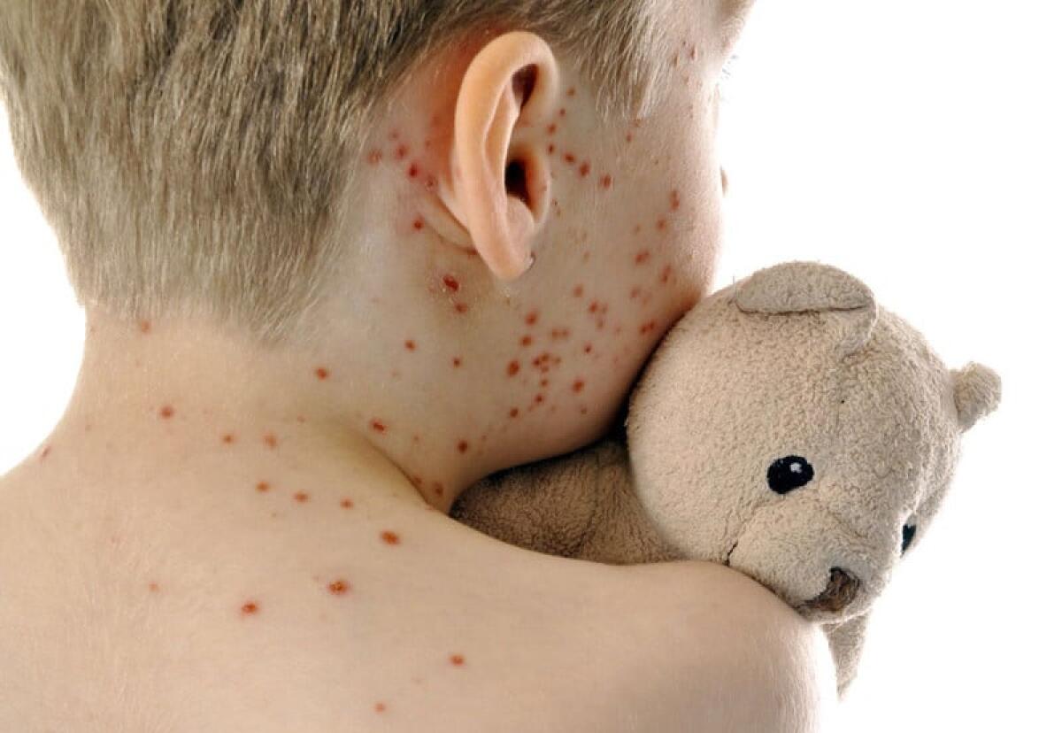 USA: Italia entra nei "viaggi a rischio" per il morbillo - Morbillo, credits: balearesuniversal.com