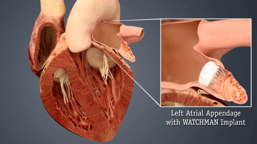 Watchman impiantato nell'atrio del cuore, come rappresentato in una ricostruzione grafica.Credits: <iframe src=