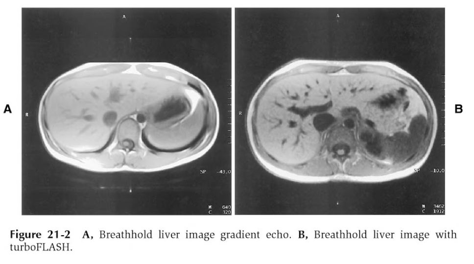 Paragone dell'acquisizione in apnea del fegato, (A) immagine gradient echo (B) immagine con TurboFlash. Credits: Magnetic Resonance Imaging, Physical and Biological principles