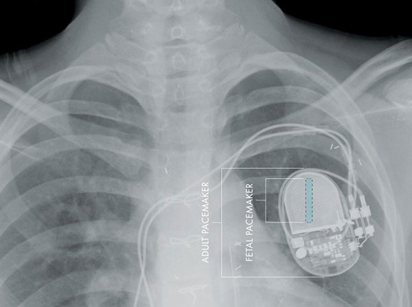 Pacemaker convenzionale e fetale a confrontohttp://keck.usc.edu
