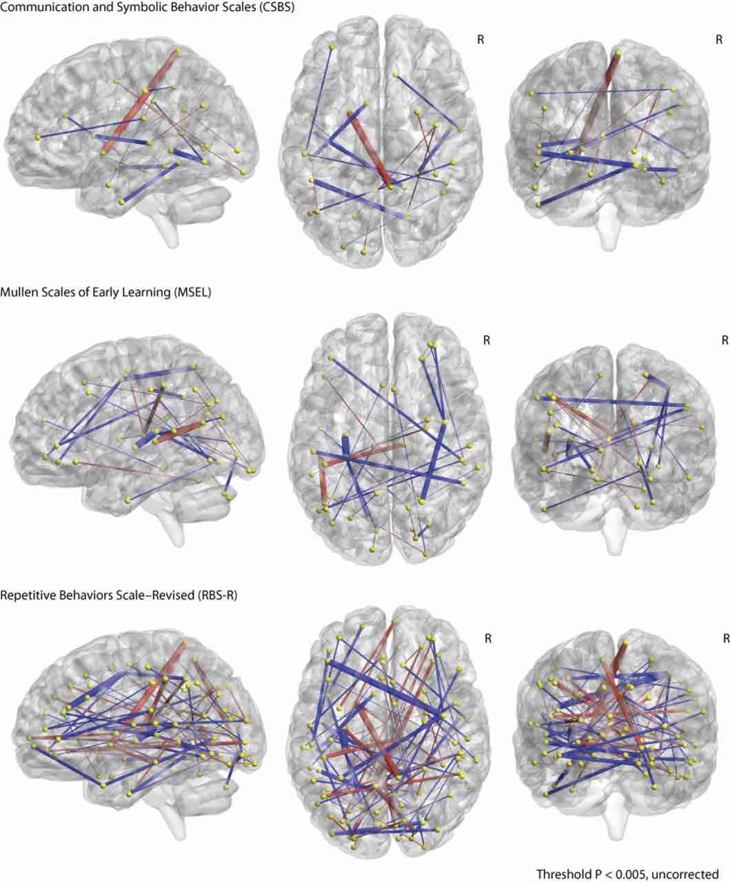 Rappresentazioni schematiche cerebrali che hanno permesso la successiva diagnosi di autismo nei bambiniR.W. Emerson et al., Science Translational Medicine (2017)