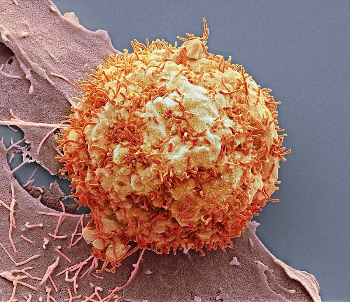 Il primo vaccino anticancro personalizzato - Carcinoma nel fegato, credits: 1.bp.blogspot.com