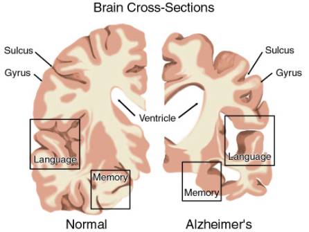 Confronto tra un cervello sano ed uno malato di Alzheimer. In particolare, vengono evidenziate le aree del linguaggio e della memoria. http://www.saluteme.it