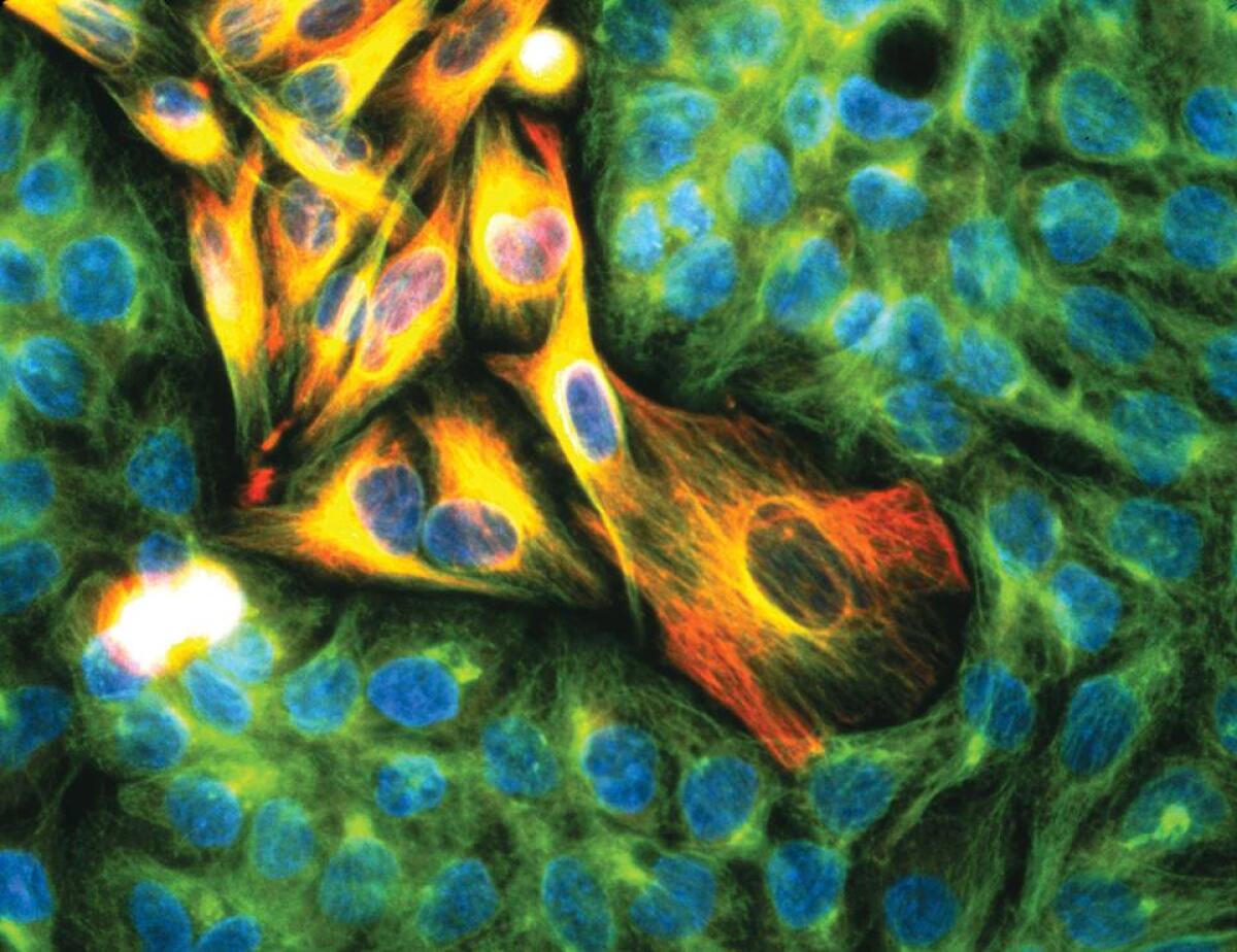 Melanoma: più vicini ad un farmaco efficace - PH: ccm-network