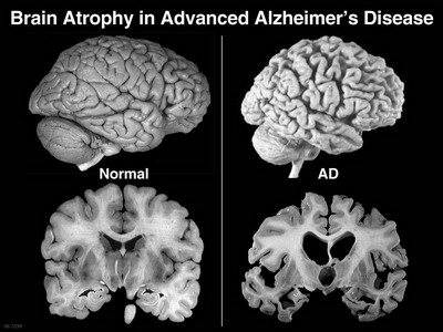 scansioni di confronto tra un cervello sano e uno affetto dal morbo di Alzheimerhttp://alzheimersneedtoknow.weebly.com