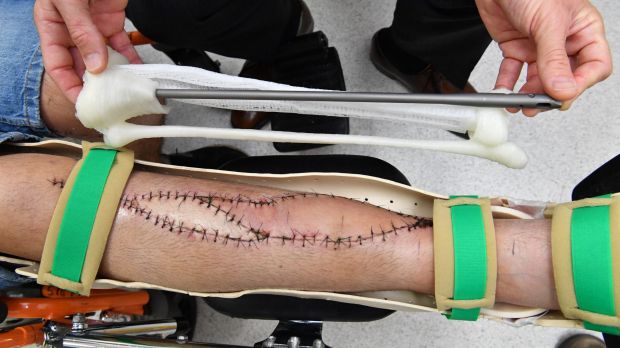Replica della tibia stampata in 3D utilizzata nell'intervento https://www.fairfaxstatic.com.au