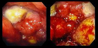 Linfoma gastricohttp://cancro-gastrico.iannetti.it