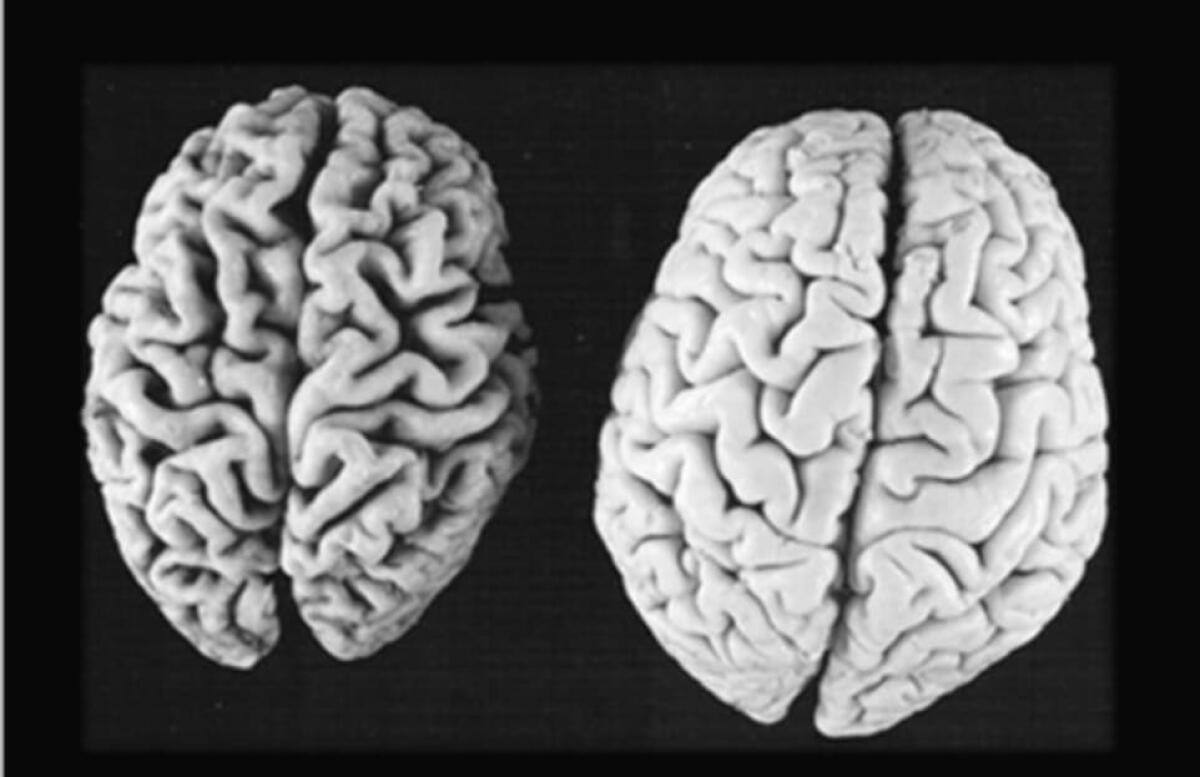 Alzheimer: comprendere la malattia per cercare una cura - Ph: lamedicinainunoscatto.it