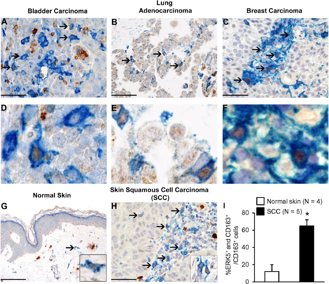 Le analisi effettuate su biopsie ottenute da carcinomi umani e dalla pelle normale hanno rilevato la presenza della proteina ERK5 (il colore marrone)  Ph: pnas.org
