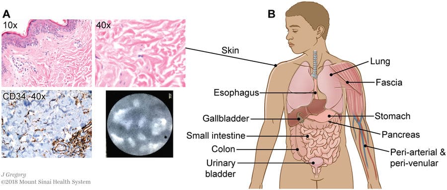 Uno spazio interstiziale si trova nel derma, nelle sottomucose e in altri tessuti fibroconnettivi in ​​tutto il corpo Ph: www.nature.com