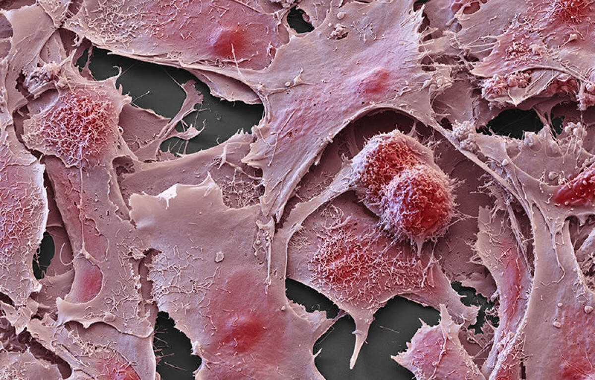 CancerSEEK: prelievo del sangue per la diagnosi di otto tipi di tumore - Ph: Eye of Science/SPL
