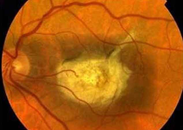 Retina di topi affetti da maculopatiaPh: liquidarea.com