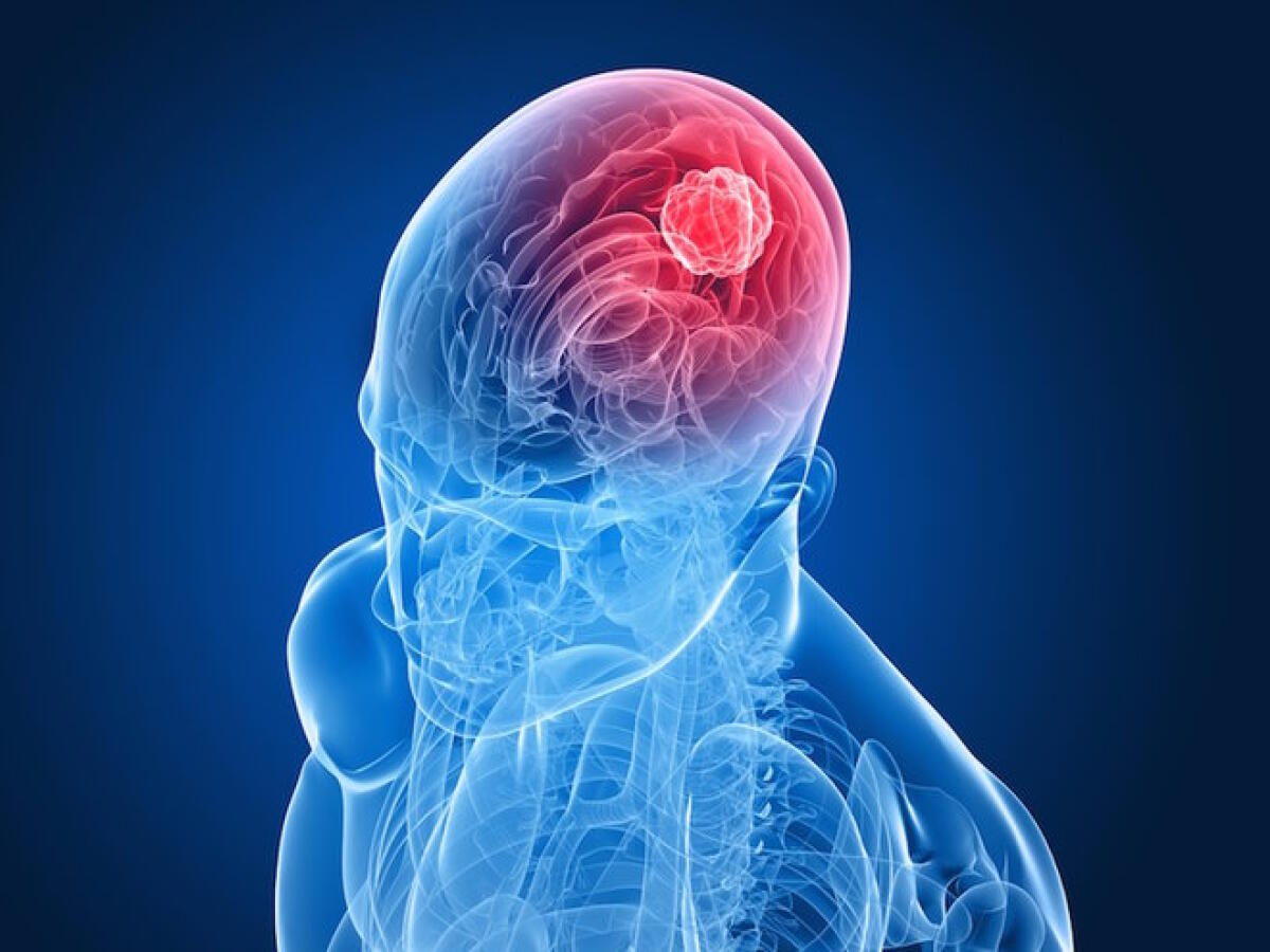 Utilizzo di ultrasuoni focalizzati per la biopsia liquida cerebrale - ultrasuoni focalizzati biopsia liquida