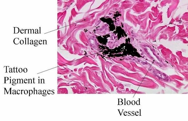 Rappresentazione istologica di una sezione di derma in cui si può osservare la localizzazione del pigmento del tatuaggio.