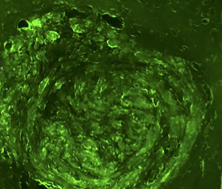 Un team della Washington University in St. Louis ha sviluppato un metodo che, grazie agli gli ultrasuoni focalizzati, permette di eseguire una biopsia liquida cerebrale. L'immagine rappresenta un tumore cerebrale in un topo. Ph: Washington University in S