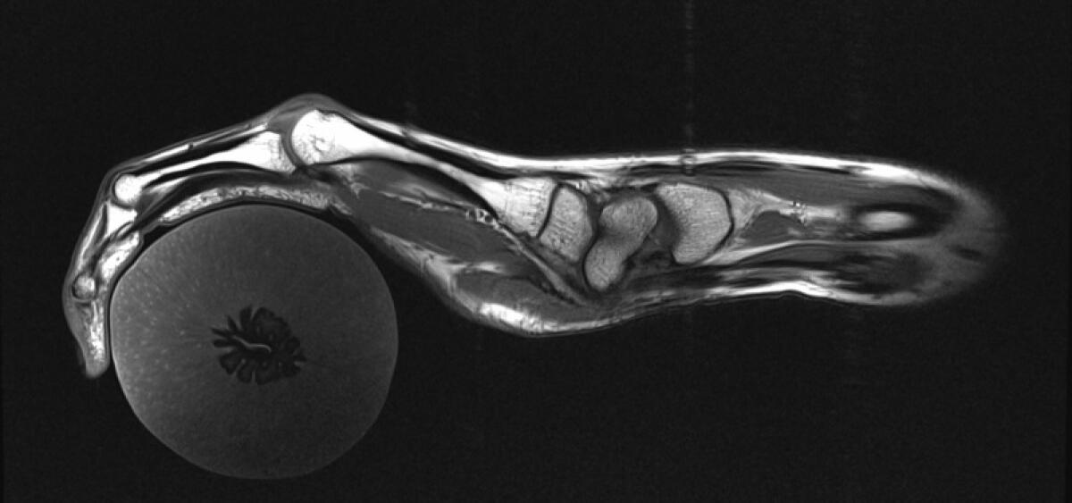 Uno scanner a forma di guanto per la risonanza magnetica della mano - MRI mano