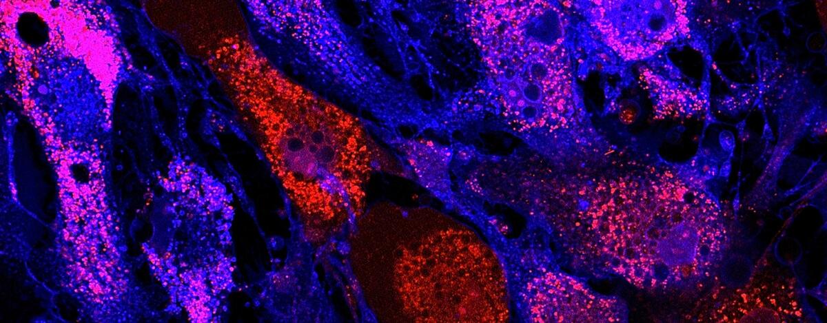 Cellule staminali contro la Sclerosi Multipla: primi tre pazienti in trattamento - Ph. stemcellnetwork.ca