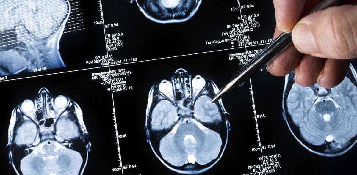 Trattamento con polio virus per combattere il cancro al cervello - 