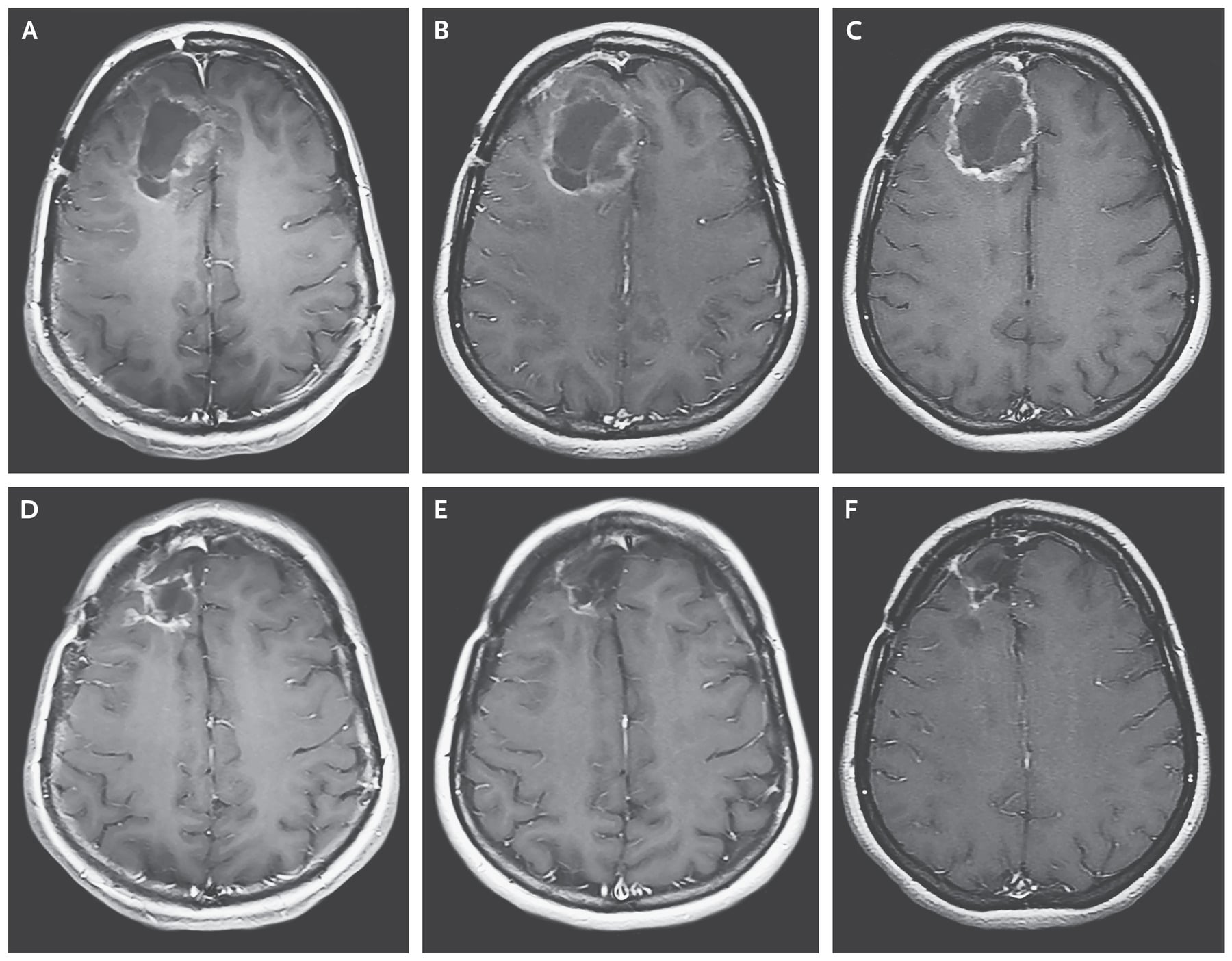 Risonanza magnetica ottenuta con l'uso di materiale di contrasto, di un paziente trattato con il poliovirusPh: nejm.org