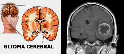 Trattamento con polio virus per combattere il cancro al cervello