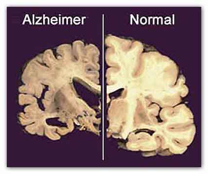 Il morbo di Alzheimer provoca una notevole riduzione del volume dell'encefalo a causa della perdita progressiva di neuroni