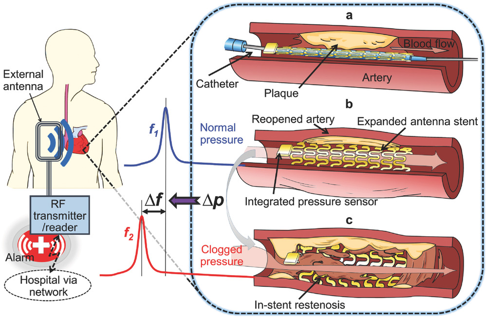 Schema concettuale dello stent e del suo funzionamento.