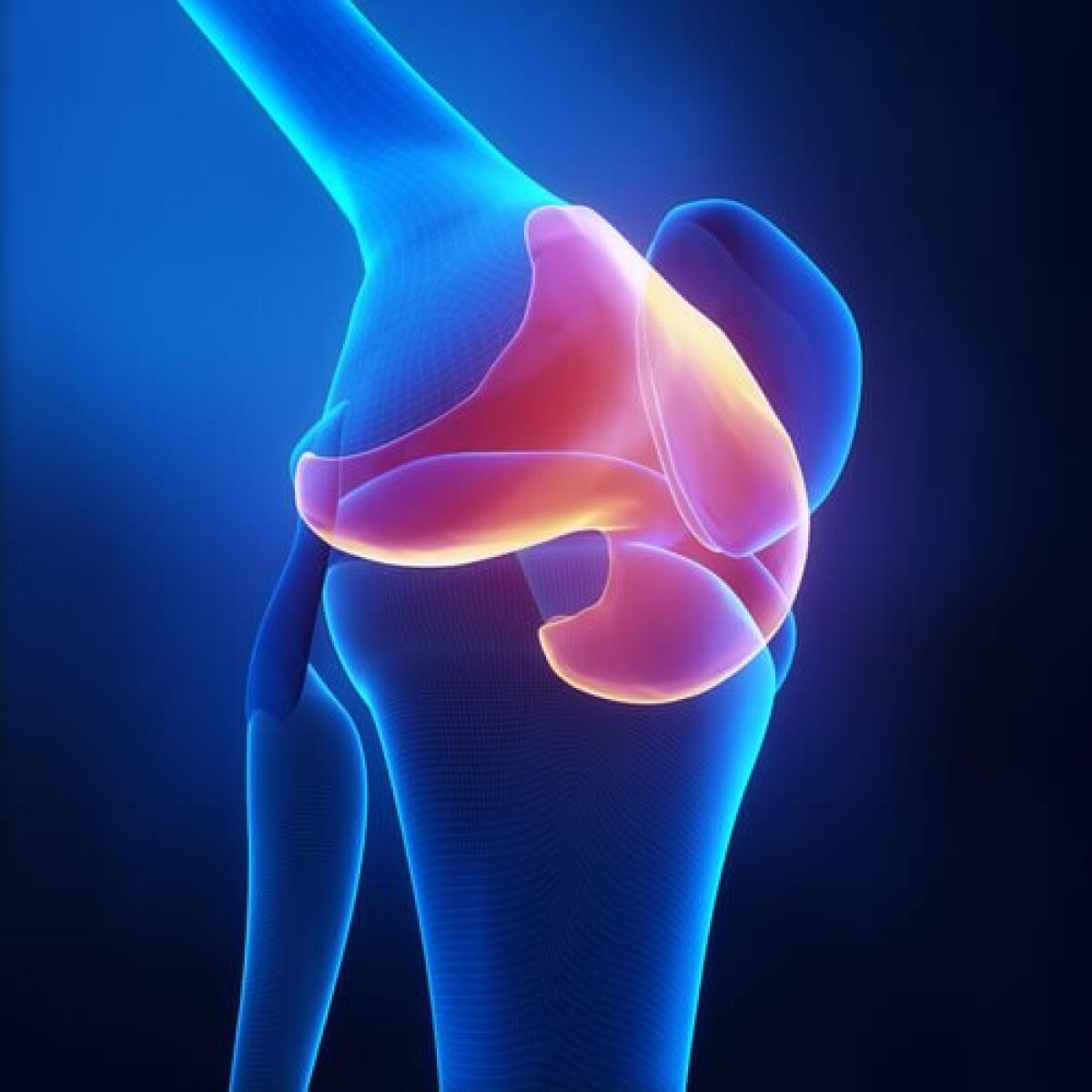 Osteoartrite: una nuovo approccio per diagnosticarla e comprenderla - osteoartrite