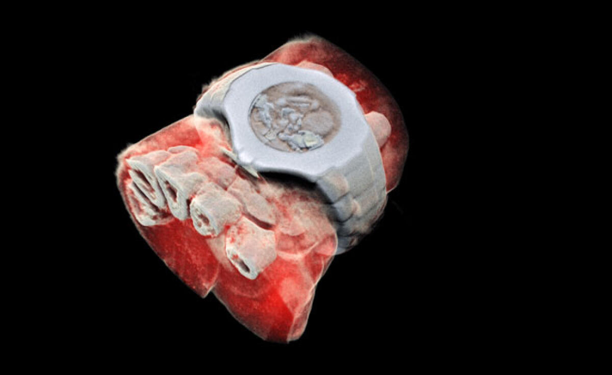 Ottenuta la prima scansione radiologica in 3D a colori - Scansione del polso del Professor Phil Butler, con tanto di orologio.
Credits: Mars Bioimaging Ltd
