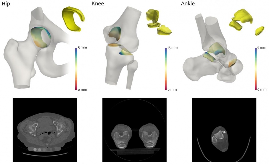 Scansione TC dell'anca, del ginocchio e della caviglia per diagnosticare l' osteoartrite.Credits: Tom Turmezei