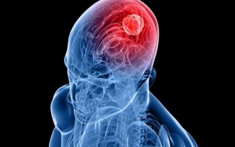 Scoperto meccanismo che causa metastasi al cervello