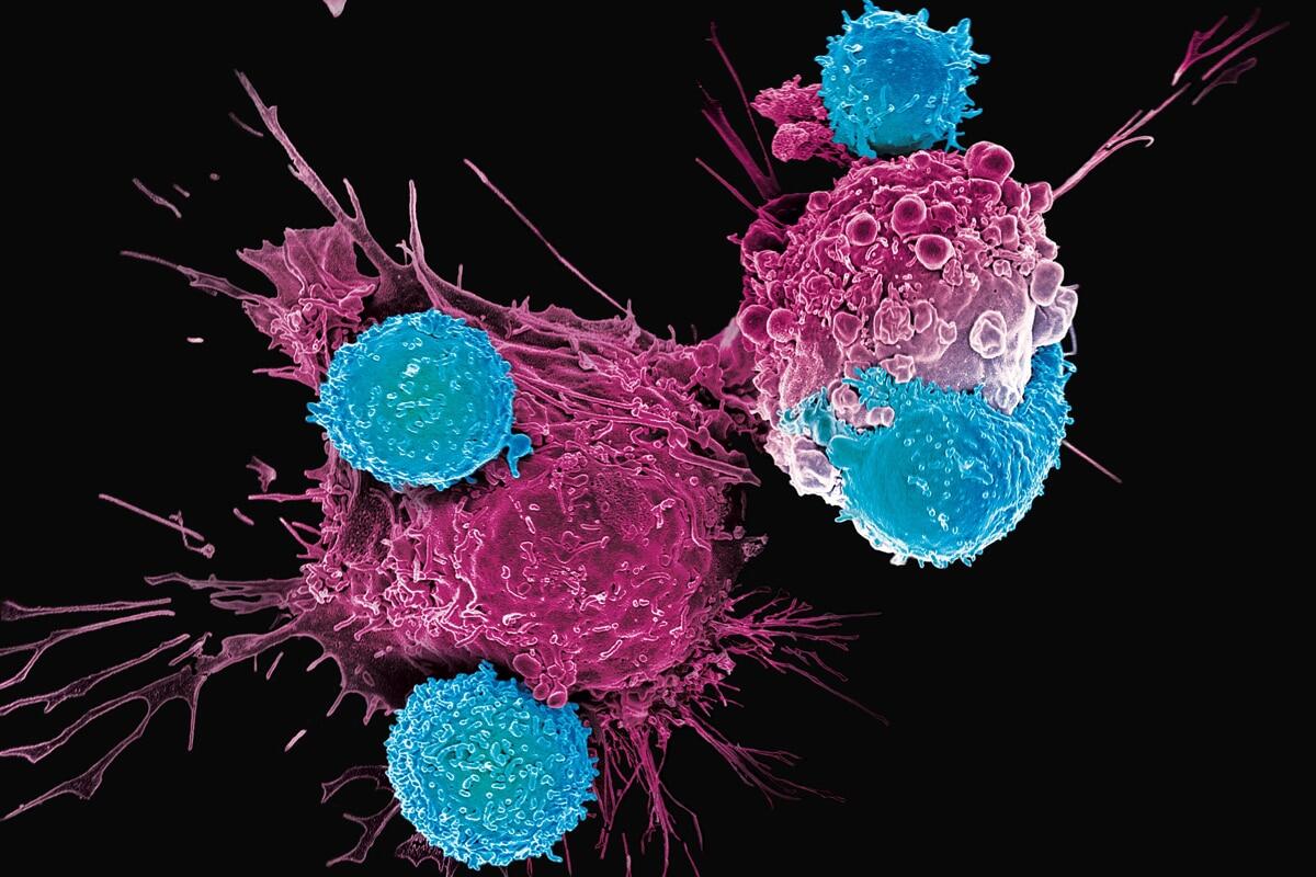 CAR-T:  la terapia genica contro il tumore è realtà - 