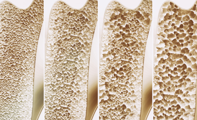 Osteoporosi: progressiva perdita di massa ossea. Ph: www.agopunturamilano.net