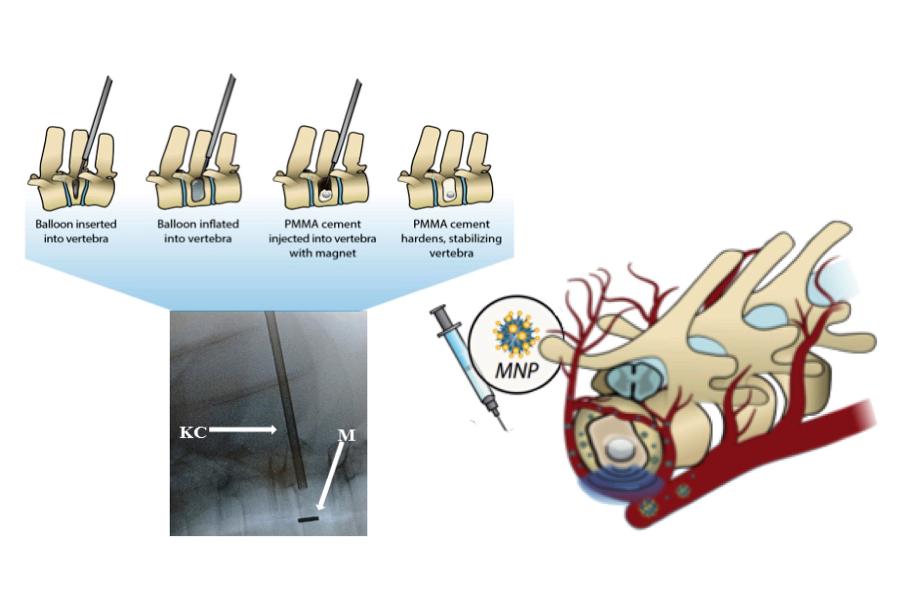 Cemento magnetico per cifoplastica. PH: UIC Today