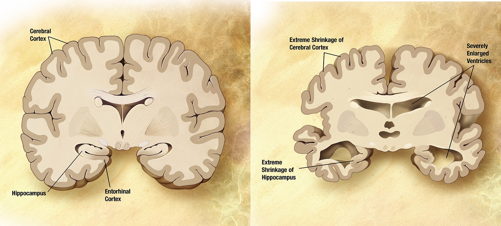 Confronto tra un cervello sano (a sinistra) e un cervello di una persona affetta da Malattia di Alzheimer (a destra)