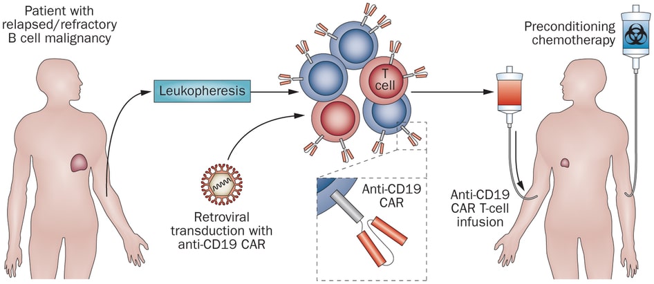 Dal paziente vengono prelevati linfociti T. Successivamente alla loro coltivazione, vengono trasfettati in modo da acquisire il gene per il recettore CAR-T. Infine, vengono reinseriti nel corpo del paziente in combinazione ad un trattamento di chemioterap