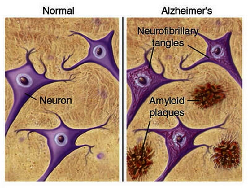 Presenza della proteina proteina amiloide nelle persone malate di Alzheimer e quelle sanePh:.medimagazine.it