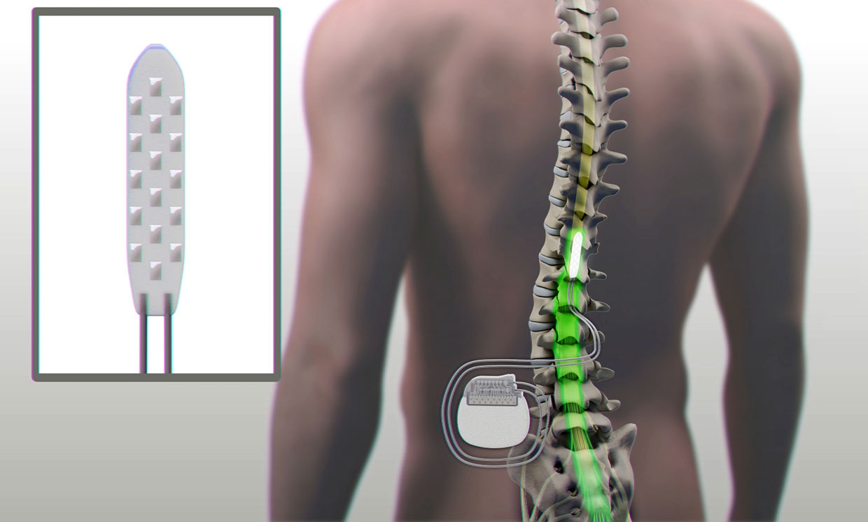 Impianto dell'elettrodo nello spazio epidurale al di sotto della zona lesa della sezione spinale del paziente, collegato a un generatore di impulsi, impiantato nella regione addominale.                        PH: spectrum.ieee.org