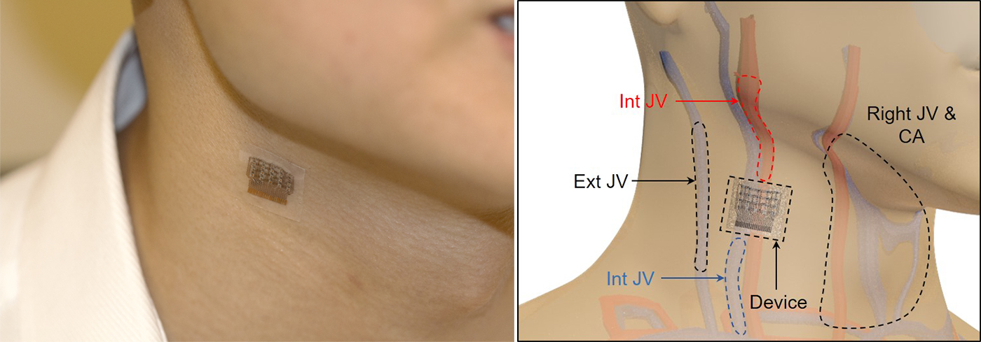 Se posizionata sul collo, la patch è in grado di monitorare la pressione nella carotide (CA), nella giugulare interna (int JV) ed esterna (ext JV)Credits: University of California San Diego