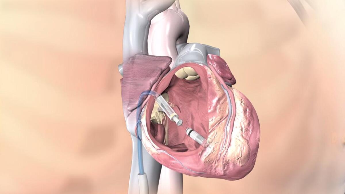 Micra TPS: il pacemaker senza fili più piccolo al mondo - PH: dicardiology,com