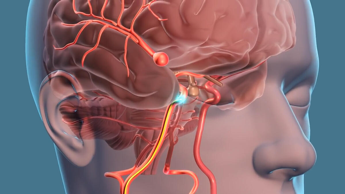 Nanosensore per il monitoraggio wireless degli aneurismi intracranici - PH:health.clevelandclinic.org