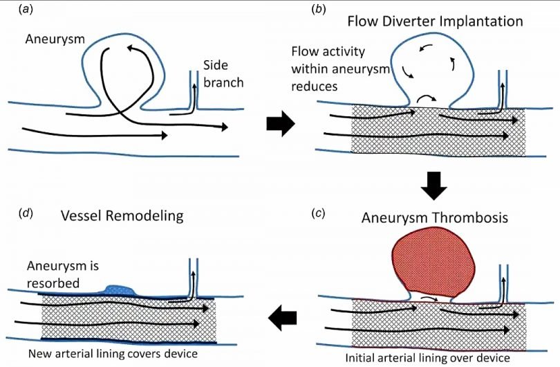 Trattamento endovascolare di aneurisma intracranico con stent flow-diverter            PH: watermark.silverchair.com
